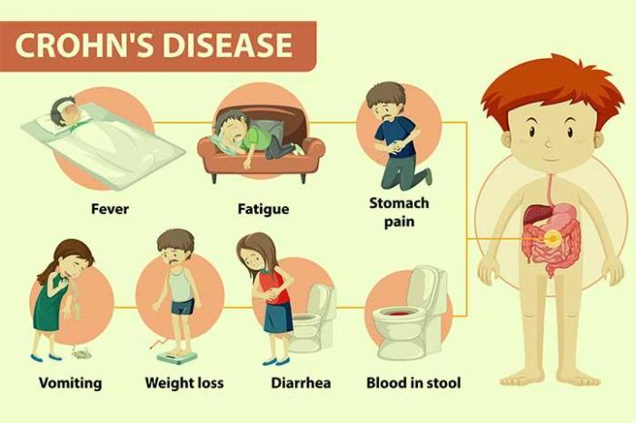 Morbus crohn ernährung kinder